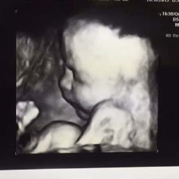 Hy hữu bà ngoại mang thai cháu gái ruột - Hình 2 Hy huu ba ngoai mang thai chau gai ruot-Hinh-2