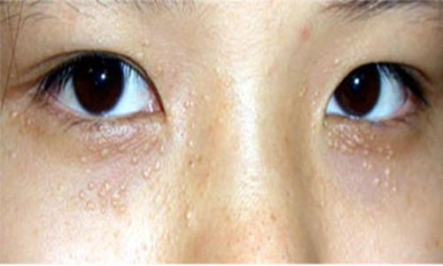 Đốm vàng quanh mắt, mũi và miệng. Có thể bạn đang bị cholesterol cao khiến các động mạch bị tắc, thể hiện trên da là những lắng đọng mỡ hình thành quanh mắt, mũi và miệng - một tình trạng được gọi là ban vàng mi mắt (xanthelasma). Bạn nên bổ sung những chất dinh dưỡng có trong các loại quả và các loại đậu.