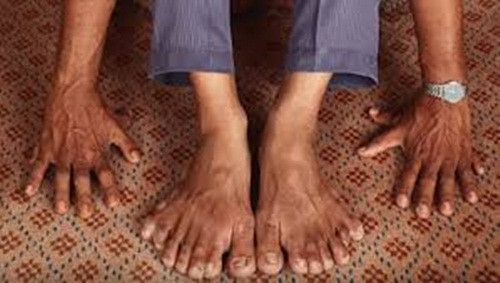 Bệnh Polydactylism là một dị tật bẩm sinh của con người có thừa một số ngón tay và ngón chân. Bệnh thường không đe dọa tới đời sống con người, song vì tính thẩm mỹ, nhiều người thường đi phẫu thuật phần thừa này.