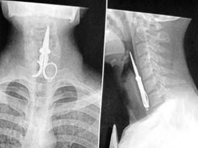 Tai nạn tai hại chảy ra với người đàn ông Trung Quốc khi mượn một chiếc kéo cắt móng tay dài khoảng 10,2 cm thay vì dùng tăm xỉa răng sau bữa ăn. Sặc cười mà anh đã nuốt chửng luôn chiếc kéo đó. Rất may bác sỹ gắp nó ra kịp thời.