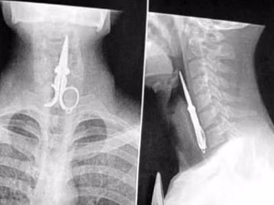 Tai nạn tai hại chảy ra với người đàn ông Trung Quốc khi mượn một chiếc kéo cắt móng tay dài khoảng 10,2 cm thay vì dùng tăm xỉa răng sau bữa ăn. Sặc cười mà anh đã nuốt chửng luôn chiếc kéo đó. Rất may bác sỹ gắp nó ra kịp thời.