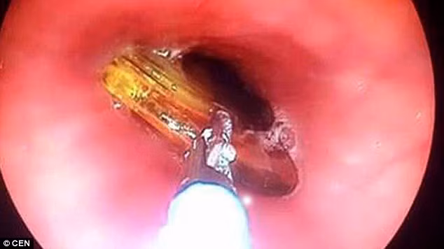 Người phụ nữ dấu tên kể lại, cô dùng chiếc lược mảnh để chọc viên thuốc đang mắc ở cổ họng nhưng không may nó tuột xuống và cô không tài nào gỡ ra được. Chiếc lược chèn ngay nơi cổ họng rồi lại trôi xuống cuống họng làm cô ngất đi và được đưa vào cấp cứu tại bệnh viện đại học Akdeniz.