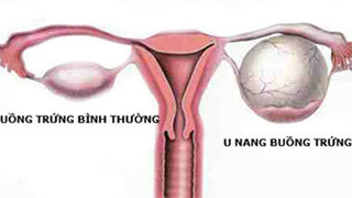 U nang buồng trứng. Là một dạng u lành tính và hoàn toàn vô hại, u nang buồng trứng có thể gặp ở phụ nữ trong bất kỳ độ tuổi nào. Các triệu chứng có thể bao gồm đau âm ỉ ở bụng. Nếu u nang lớn có thể đau xoắn bụng.