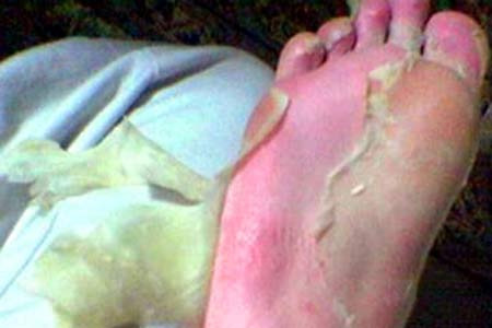 Bong da chân. Dù bạn không hoạt động nhiều mà đôi chân vẫn chai và bong da thì nên xem lại. Có thể bạn đã nhiễm nấm do môi trường ẩm ướt hay hồ bơi.