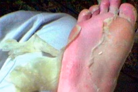 Bong da chân. Dù bạn không hoạt động nhiều mà đôi chân vẫn chai và bong da thì nên xem lại. Có thể bạn đã nhiễm nấm do môi trường ẩm ướt hay hồ bơi.