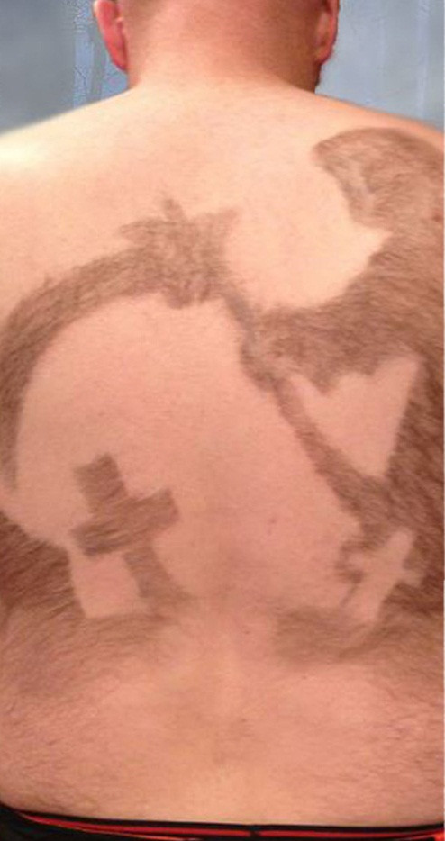 Đến năm 2008, anh quyết định phải biến nhược điểm cơ thể thành ưu điểm nhờ vào người bạn thân là một thiết kế đồ họa tạo nên những bức họa bằng chính những đám lông rậm rạp của mình.