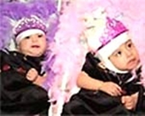 Đã có những trường hợp được tách rời như 2 chị em người Guatemala Laria Teresa và Maria de Jesus Quiej Alvarez, sinh năm 2000, dính nhau phần đỉnh đầu. Maria de Jesus đang dần hồi phục nhưng các bác sĩ vẫn phải theo dõi sức khỏe, đặc biệt là khả năng nhiễm trùng não, còn Laria Teresa qua đời sau đó.