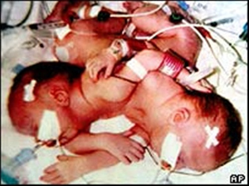 Hay một trong những ca mổ tách được dư luận chú ý nhiều nhất được thực hiện năm 1993 tại Mỹ; bệnh nhân là 2 chị em Angela và Amy Lakeberg, lúc đó 7 tháng tuổi, chung nhau một trái tim và một buồng gan.