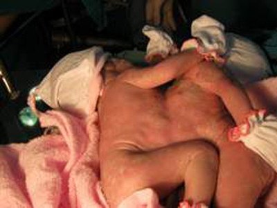 Ở Đồng Nai cũng đã có trường hợp hy hữu cặp sơ sinh dính liền bụng nhau nhưng rất tiếc hai bé cũng không thể sống được. Hai bé qua đời không phải vì suy kiệt mà do tim dị tật dẫn đến rối loạn huyết động khiến quá trình cung cấp oxy không tốt, thiếu oxy cho não.