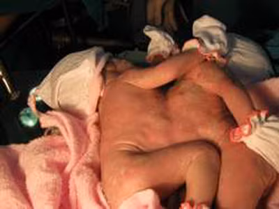 Ở Đồng Nai cũng đã có trường hợp hy hữu cặp sơ sinh dính liền bụng nhau nhưng rất tiếc hai bé cũng không thể sống được. Hai bé qua đời không phải vì suy kiệt mà do tim dị tật dẫn đến rối loạn huyết động khiến quá trình cung cấp oxy không tốt, thiếu oxy cho não.