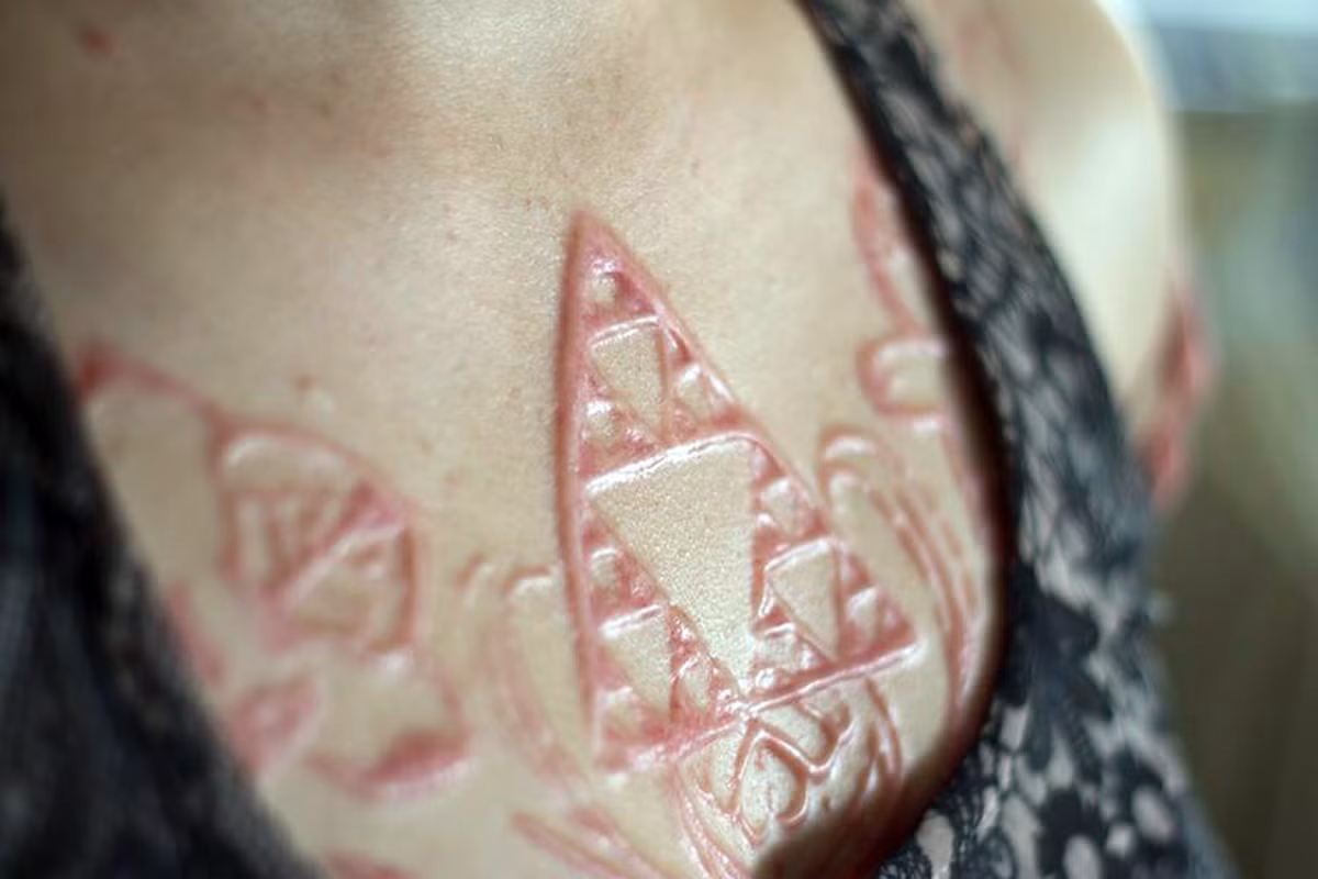 Thậm chí nhiều tháng sau khi trái nắng trở trời cô vẫn cảm thấy thi thoảng như bị sốc điện. Những vết sẹo làm da thịt đau nhói.