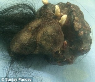 Được biết, chàng trai này thường xuyên chịu đựng những cơn đau bụng dữ dội, nôn mửa và sụt cân nhưng gia đình không hề để ý. Chỉ sau khi bác sỹ phẫu thuật để lấy khối bào thai có tóc và răng ra thì gia đình mới ngã ngửa.