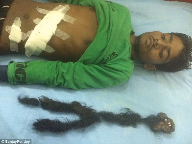 Anh chàng 18 tuổi Narendra, người Ấn Độ đã bị đau bụng kinh niên phải nhập viện. Tại đây, các bác sỹ vô cùng sốc khi phát hiện một bào thai chết lưu ký sinh nặng 2,5kg chứa đầy răng và tóc trong bụng anh.