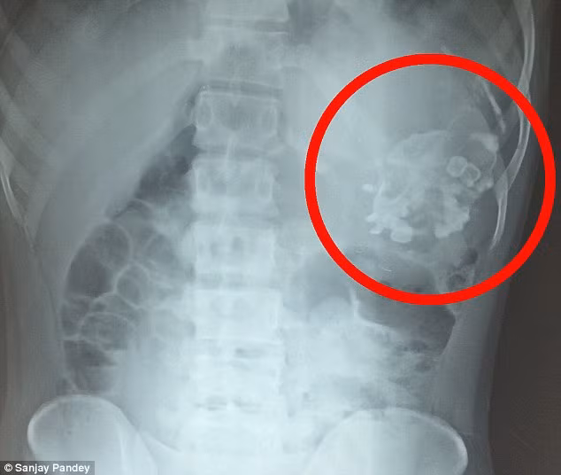 Đây được gọi là hiện tượng "thai trong thai", hay còn gọi là song sinh ký sinh, rất hiếm gặp trên thế giới, chỉ xảy ra với tỷ lệ 1/500.000 trẻ, hiện mới có khoảng dưới 200 trường hợp mắc hội chứng kỳ lạ này.