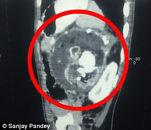 Ca phẫu thuật kéo dài 3 giờ đồng hồ, các bác sỹ đã loại bỏ một bào thai chết lưu của một em bé có răng, tóc và đầu không phát triển, có cấu trúc xương ngực, cột sống và rất nhiều ối màu vàng lỏng.