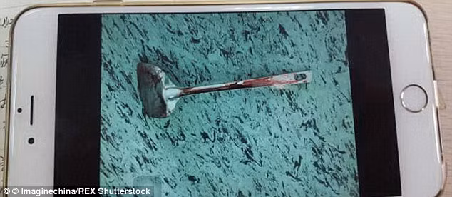 Kết quả bà phải nhập viện và các bác sỹ bắt buộc phải phẫu thuật khẩn cấp. Họ buộc phải cắt đi 20cm thực quản bị đâm nát bởi chiếc thìa.