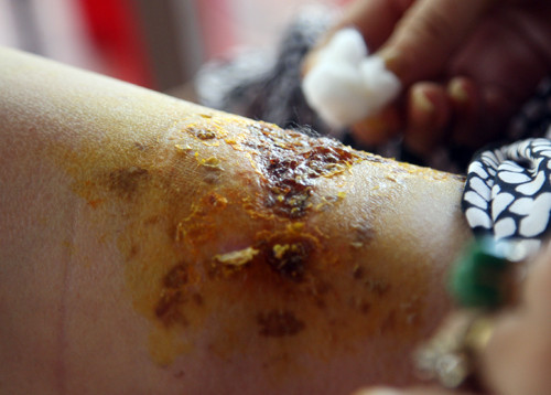 Hay như ông Aspinall 48 tuổi, ở Wigan, Greater Manchester để thuốc lá điện tử trong túi quần, do quá nóng điếu thuốc đã phát nổ. Vụ nổ hi hữu đã làm chân phải của Aspinall gần như bị xé đôi và một phần căn nhà của ông bị cháy.