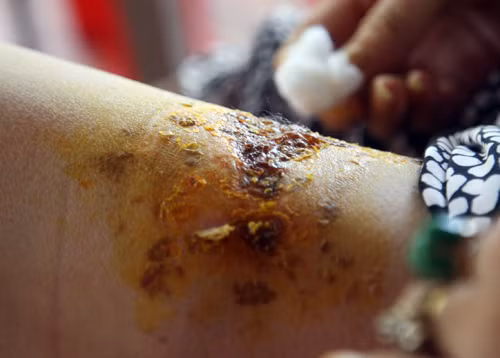 Hay như ông Aspinall 48 tuổi, ở Wigan, Greater Manchester để thuốc lá điện tử trong túi quần, do quá nóng điếu thuốc đã phát nổ. Vụ nổ hi hữu đã làm chân phải của Aspinall gần như bị xé đôi và một phần căn nhà của ông bị cháy.