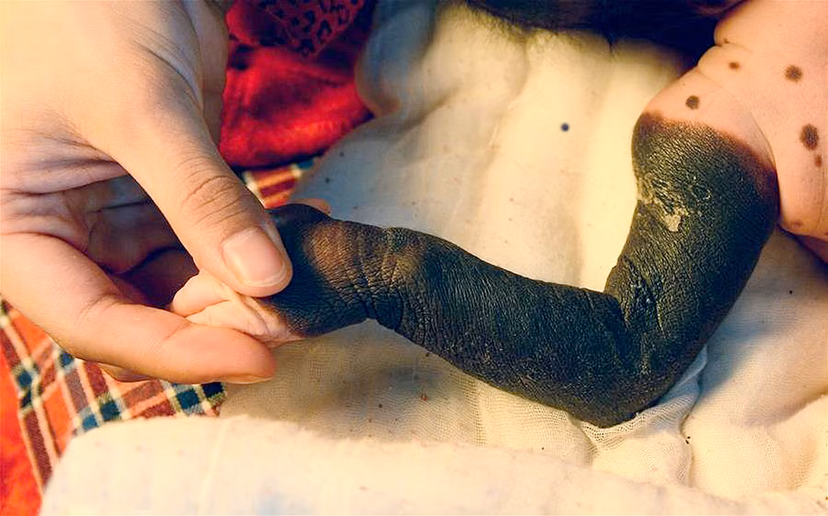 Cha của em bé cho hay, anh chưa bao giờ tưởng tượng con mình sinh ra bị tình trạng như vậy nhưng cũng cảm thấy nhẹ nhõm hơn khi bác sỹ cho biết không quá khó để xóa bỏ những vết bớt.