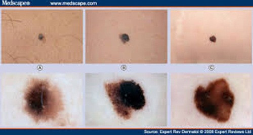 Tuy các vết bớt không gây ra bất cứ đau đớn gì cho thể xác nhưng chúng vẫn thường được loại bỏ để ngăn ngừa ung thư cũng như các vấn đề về tâm lý của người bệnh trong tương lai.