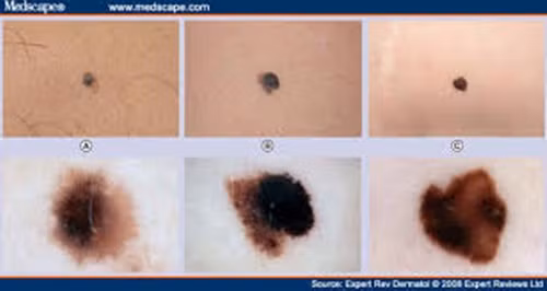 Tuy các vết bớt không gây ra bất cứ đau đớn gì cho thể xác nhưng chúng vẫn thường được loại bỏ để ngăn ngừa ung thư cũng như các vấn đề về tâm lý của người bệnh trong tương lai.