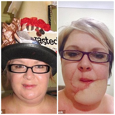 Thế nhưng, kỳ lạ là cục u nang mỡ càng ngày càng sưng to và gây nhức khắp khuôn mặt khiến cô Jodie bắt buộc phải đến bệnh viện một lần nữa. Sau khi được bác sỹ phân tích sinh thiết thì họ cho biết, đó không chỉ đơn thuần là u nang mỡ mà là một loại ung thư hiếm gặp.