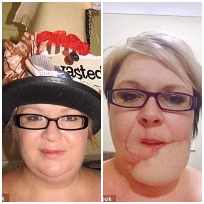 Thế nhưng, kỳ lạ là cục u nang mỡ càng ngày càng sưng to và gây nhức khắp khuôn mặt khiến cô Jodie bắt buộc phải đến bệnh viện một lần nữa. Sau khi được bác sỹ phân tích sinh thiết thì họ cho biết, đó không chỉ đơn thuần là u nang mỡ mà là một loại ung thư hiếm gặp.