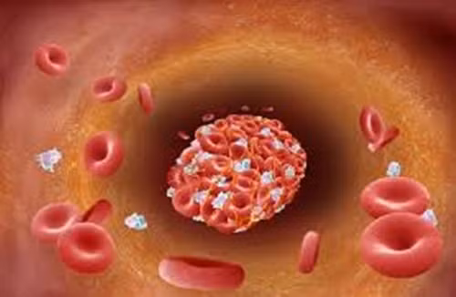 Có thể là cục máu đông trong chân rất nguy hiểm, nếu nó bị vỡ ra có thể gây tử vong. Nếu bạn xoa bóp thì cục máu đông có thể di chuyển vào phổi khiến bạn tử vong.