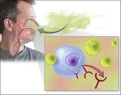 Viêm mũi dị ứng. Tuy là bệnh thường gặp thế nhưng rất nhiều người chủ quan. Bệnh do viêm nhiễm xảy ra trên bề mặt hốc mũi. Bệnh viêm mũi không được điều trị đúng cũng có thể gây ra viêm tai giữa ảnh hưởng đến khả năng nghe.