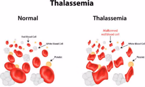 Benh tan mau bam sinh la gi va nguy hiem nhu the nao?