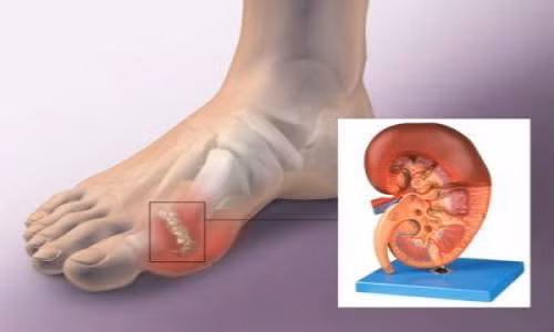 Biểu hiện lâm sàng đặc trưng bệnh gout thường là sưng tấy, nóng, đỏ, đau dữ dội tại một hay nhiều khớp. Nhưng vì sao bệnh nhân gout thường có những cơn đau về đêm? Ảnh: sj88.