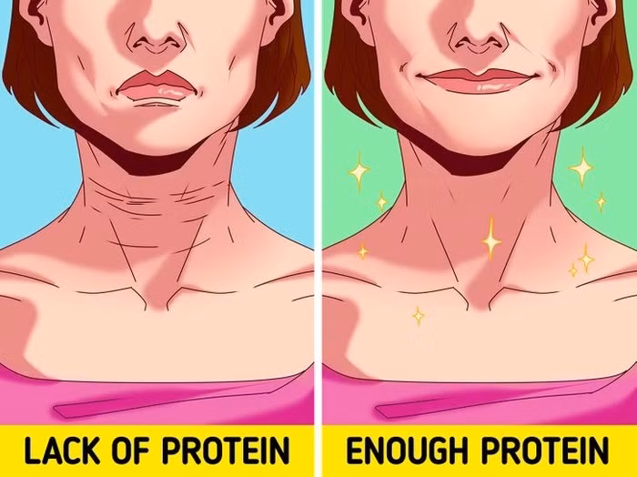 5. Thiếu protein Chế độ ăn hạn chế lượng calo và quá ít protein có thể ngăn cản các tế bào da tự tái tạo, khiến da của bạn mất độ đàn hồi, từ đó dẫn đến nhiều nếp nhăn hơn. Điều trị bằng collagen cũng có thể giúp ích trong những trường hợp này nhưng nó không đáng kể gì so với những ảnh hưởng của việc thiếu protein. 