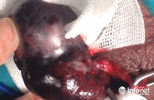 Cuc ky nguy hiem benh ly cap tinh xoan tinh hoan