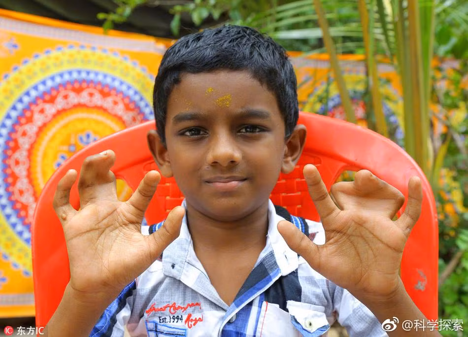 Trong ảnh là cậu bé Advaith, 7 tuổi, thành viên của một dòng họ có tới 140 thành viên mắc căn bệnh tay dính liền như thế này. (Nguồn Sina)