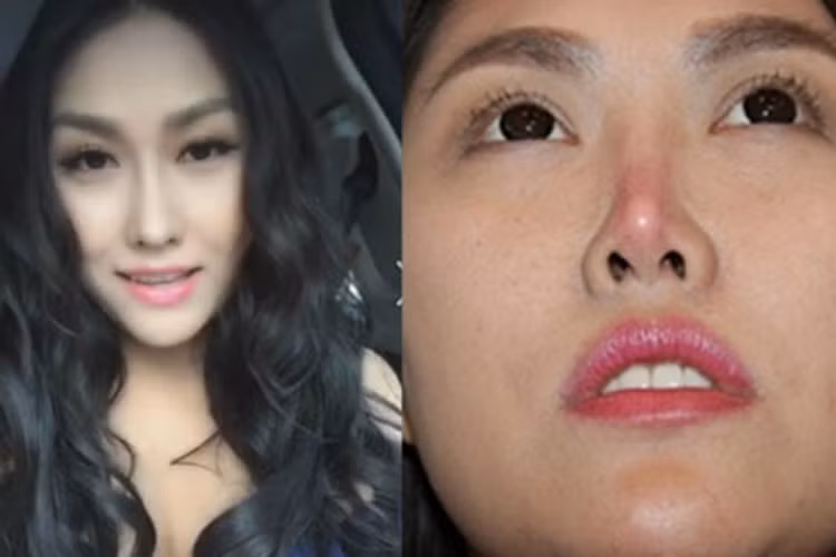 Tháng 5/2015, nữ diễn viên phim “Cô gái xấu xí” sửa mũi bị biến dạng. Sau lần dao kéo này, gương mặt của Phi Thanh Vân trở nên hài hòa hơn trước. Ảnh: Khỏe và đẹp