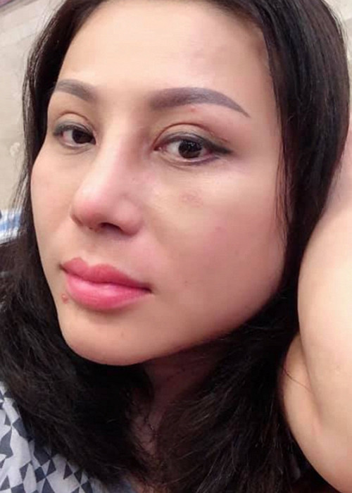 Hình ảnh gương mặt của Quỳnh Như còn sưng sau khi mới phẫu thuật thẩm mỹ.