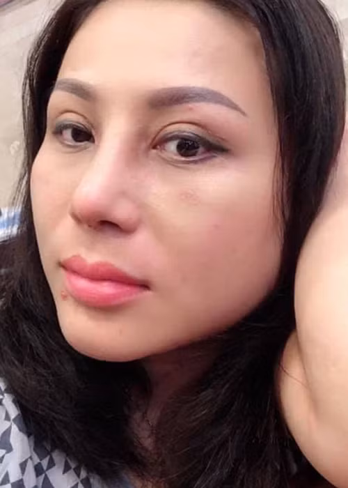 Hình ảnh gương mặt của Quỳnh Như còn sưng sau khi mới phẫu thuật thẩm mỹ.