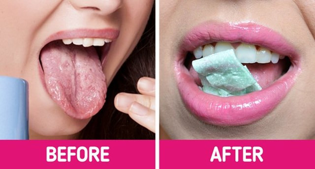 4.Đặt kẹo cao su bạc hà ngay lên vùng bị bỏng: Chỉ cần đặt một miếng kẹo cao su bạc hà lên vùng bị thương và không nhai. Bạc hà là một phương pháp khắc phục đơn giản và nhanh chóng có thể giúp ích cho bạn nhờ tinh dầu bạc hà giúp kích hoạt các vùng cảm ứng lạnh. Nó sẽ mang lại cho bạn cảm giác mát lạnh, vì vậy bạn sẽ bắt đầu cảm thấy dễ chịu hơn một cách tự nhiên.