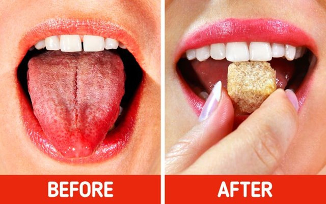 6.Liếm một chút sô cô la hoặc đường: Đặt đường cát lên lưỡi và ấn lên vòm miệng. Bạn cũng có thể sử dụng bất kỳ sản phẩm nào có chứa đường - như kem que hoặc thanh sô cô la. Đường cát được biết là được sử dụng để điều trị vết thương mà khó có thể chữa lành. Nó sẽ giúp giảm cơn đau khó chịu ban đầu.