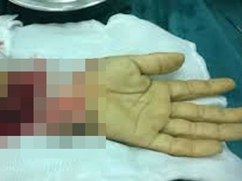  4. Chém đứt lìa bàn tay người khác: Ngày 25/10, Công an huyện Lộc Ninh (Bình Phước) đang tạm giữ hình sự Huỳnh Xuân Bình (SN 2004, ngụ huyện Bù Đốp) để điều tra làm rõ về hành vi cố ý gây thương tích. Trưa 19/10, do mâu thuẫn giữa 2 nhóm thanh niên xảy ra tại ấp Hiệp Hoàn, xã Lộc Hiệp, huyện Lộc Ninh, nên Bình đã dùng mã tấu chém đứt rời bàn tay phải của Nguyễn Văn M. (SN 1999, ngụ xã Lộc Hiệp, huyện Lộc Ninh).