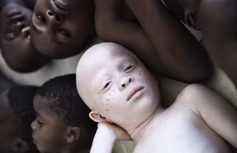 Những đứa trẻ bạch tạng thường xuyên bị bắt, hoặc bị cắt chân, tay để tế lễ, hoặc bị giết một cách tàn nhẫn do mê tín. (Nguồn Sina)