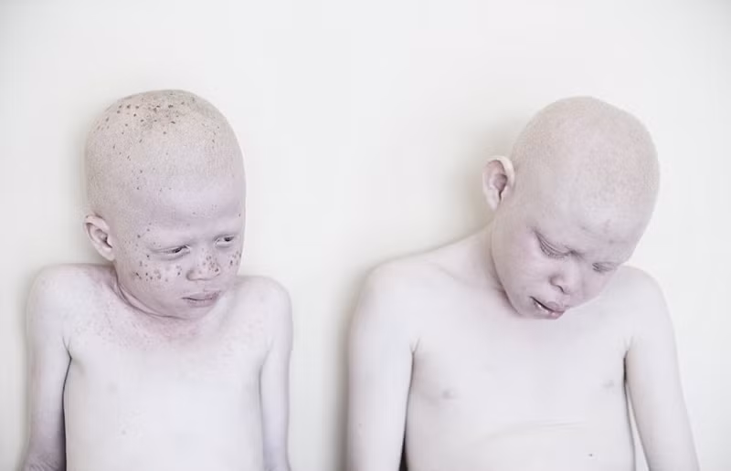 Hết sức phẫn nộ và thương xót cho số phận những đứa trẻ bị bạch tạng, Marinka Masséus quyết định chụp lại những bức ảnh của các em với hi vọng, vẻ đẹp tiềm ẩn của những trẻ em bị bạch tạng sẽ chạm đến trái tim của người xem. (Nguồn Sina)