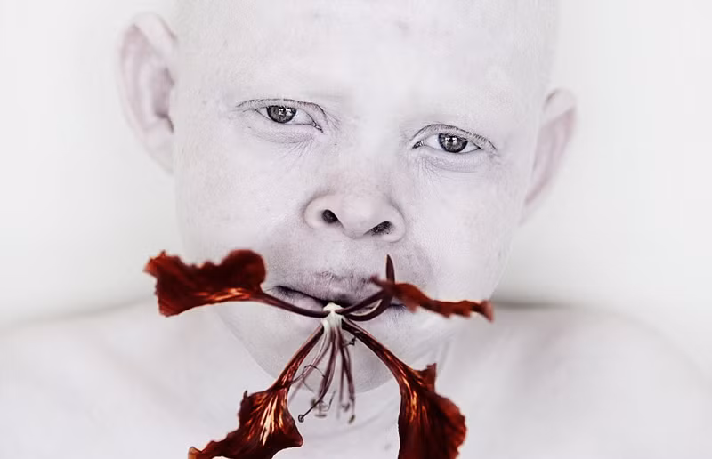 Tháng 12/2014, một bé gái bạch tạng 4 tuổi bị bắt cóc từ tay mẹ, cho đến nay cảnh sát vẫn chưa tìm thấy tung tích của cô bé. Tháng 2/015, một cậu bé 18 tháng tuổi mắc chứng bạch tạng đã bị bắt đi ngay trong nhà của cậu, đến khi tìm thấy, cơ thể cậu bé đã bị cắt làm nhiều mảnh một cách tàn nhẫn. (Nguồn Sina)