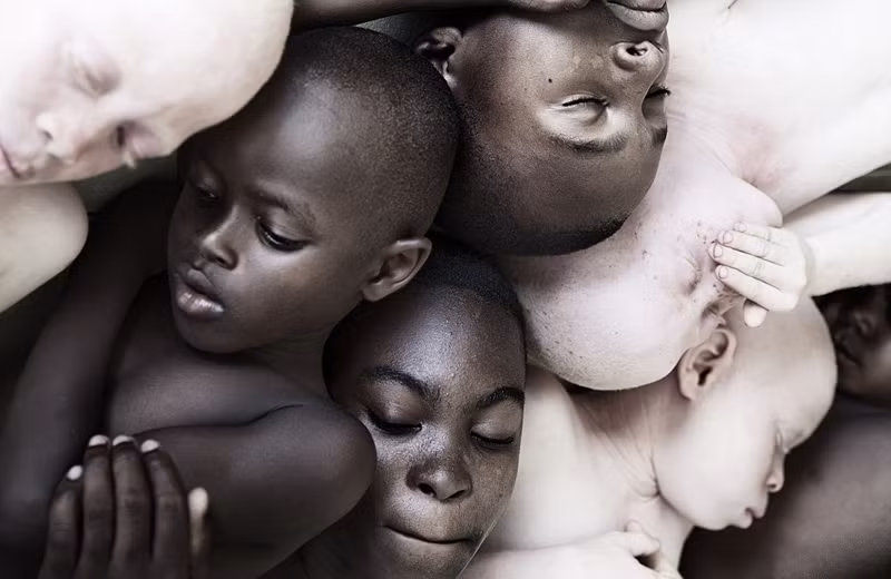 Do giao phối cận huyết nên một số nước ở Đông Phi và Tanzania có nguy cơ bị bệnh cao hơn nhiều. (Nguồn Sina)