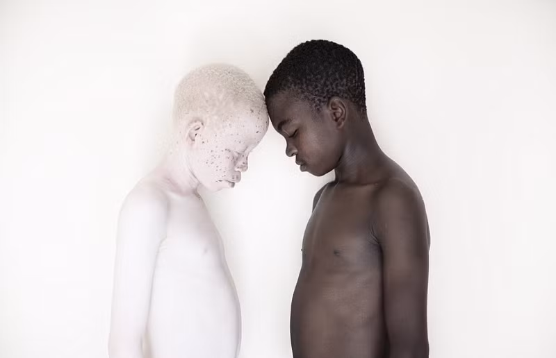 Hiện nay, chính phủ Tanzania đang nỗ lực tích cực để giảm sự ảnh hưởng của các thầy thuốc phù thủy, ngoài ra còn cung cấp kem chống nắng cho các trẻ em bị bệnh để tránh tác động của anh sáng mặt trời. (Nguồn Sina)