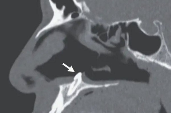 Thay kho tho, di kiem tra ta hoa phat hien rang moc trong mui