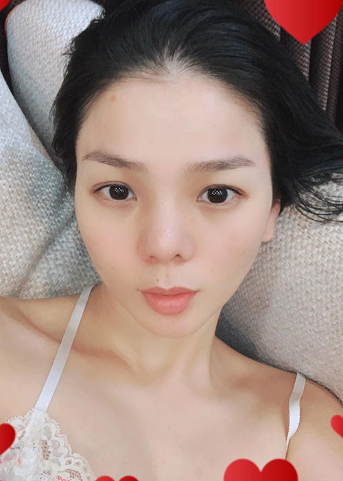 Lệ Quyên tháo sụn mũi cách đây không lâu sau khi chiếc mũi dao kéo của nữ ca sĩ phòng trà gặp biến chứng nặng. Sở hữu chiếc mũi tự nhiên, cô cảm thấy yên tâm với ngoại hình mới.