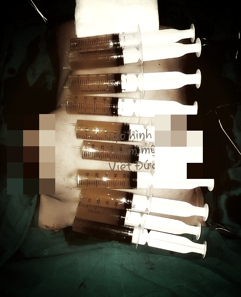 Nguc co gai sap “no tung”, bac si ta hoa hut dich