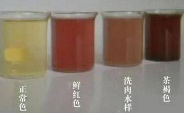 Màu nước tiểu bất thường. Ở người khỏe mạnh, nước tiểu sẽ có màu vàng nhạt, không có mùi hôi. Ngược lại, nếu nước tiểu chuyển màu nâu đen, nhiều bọt lâu tan thì bạn cần cảnh giác tình trạng axit uric cao.