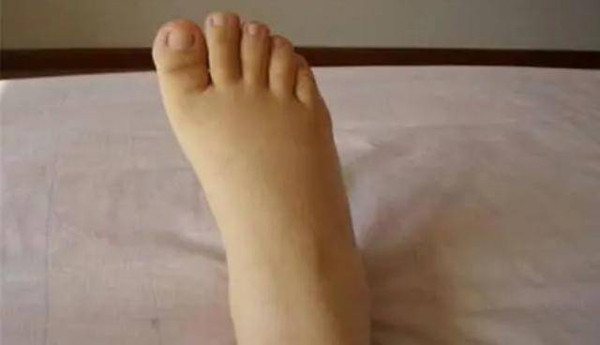 Phù nề. Phù hai chi dưới vào ban đêm là dấu hiệu axit uric cao cần chú ý. Được biết, ban đêm là thời điểm hàm lượng axit uric trong cơ thể cao nhất. Axit uric cao sẽ gây tổn thương cho thận, ảnh hưởng đến quá trình bài tiết nước. Một khi quá trình bài tiết trục trặc, lượng lớn nước sẽ tích tụ trong cơ thể, gây nên tình trạng phù nề. (Ảnh: Sohu, minh họa)